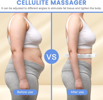 Cellulite Remover Massager – Detachable Handles, Smooth Glide for Legs & Arms, Skin Tightening