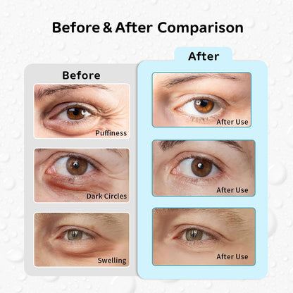 4PCS Gel Eye Ice Pack Set Reusable, Cold and Hot Compress for Eyes, Ice Pack for Eyes, Cooling Eye Pads for Eye Strain, Swelling, Redness, Dark Circles, Puffy Eyes, and Eye Recovery Surgery.