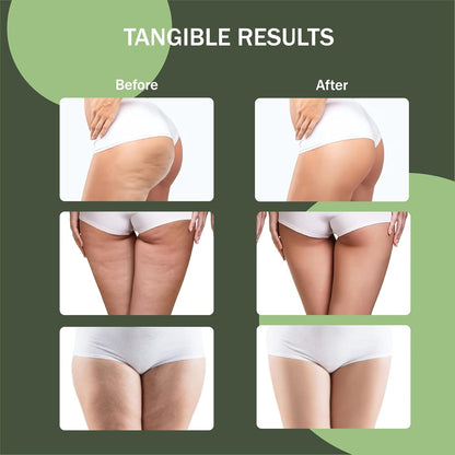 Cellulite Manual Massager - Lymphatic Drainage Massager with Detachable Handles - Reduce Cellulite and Stretch Marks on Legs and Body